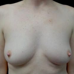 Nipple Inversion Before & After Patient #22147