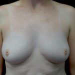 Nipple Inversion Before & After Patient #22147