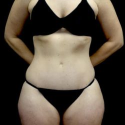 Tummy Tuck Before & After Patient #22093
