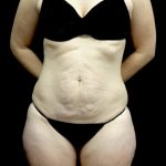 Tummy Tuck Before & After Patient #22093