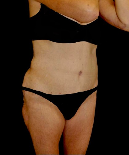 Tummy Tuck Before & After Patient #22261