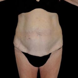 Tummy Tuck Before & After Patient #22261