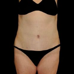 Tummy Tuck Before & After Patient #22261
