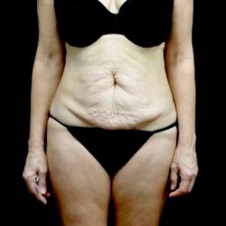 Tummy Tuck Before & After Patient #22128