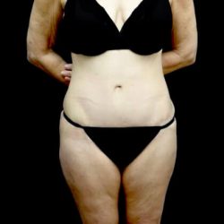 Tummy Tuck Before & After Patient #22128