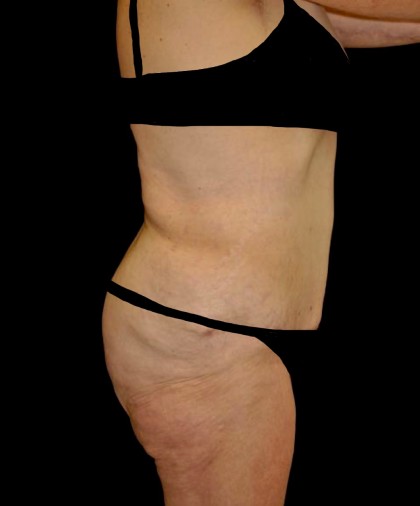 Tummy Tuck Before & After Patient #22261
