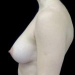 Asymmetric Tuberous Breasts Before & After Patient #22086