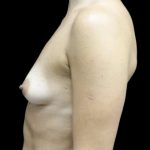 Asymmetric Tuberous Breasts Before & After Patient #22086