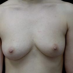 Breast Augmentation (Fat Transfer) Before & After Patient #22072