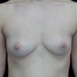 Breast Augmentation (Fat Transfer) Before & After Patient #22072