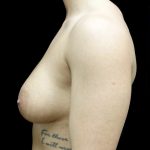 Breast Lift Before & After Patient #22382