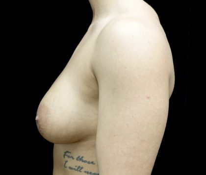 Breast Lift Before & After Patient #22382
