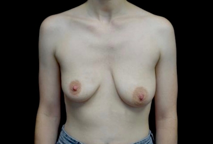 Breast Lift with Implants Before & After Patient #22156