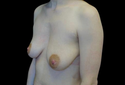 Breast Lift with Implants Before & After Patient #22156