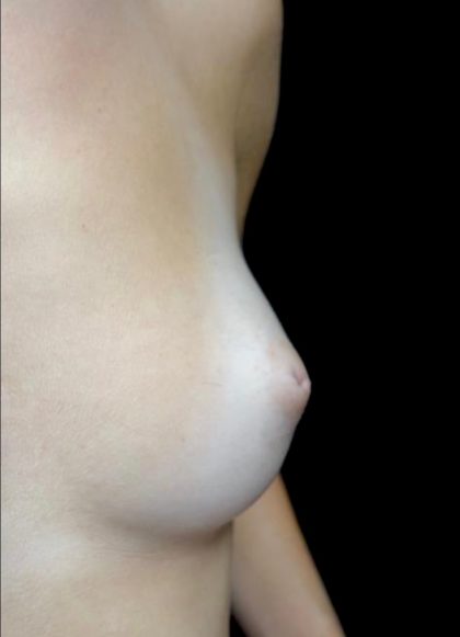 Nipple Inversion Before & After Patient #22185