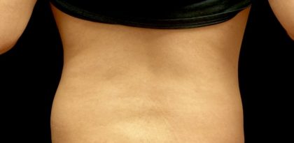 CoolSculpting Before & After Patient #22058