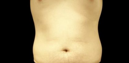 CoolSculpting Before & After Patient #22058