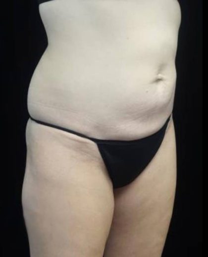 CoolSculpting Before & After Patient #22270