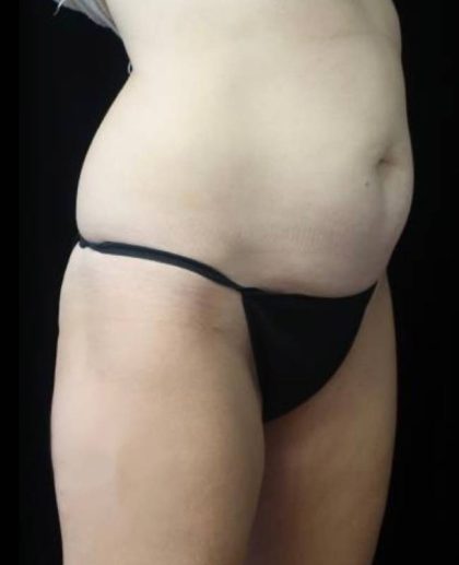 CoolSculpting Before & After Patient #22270