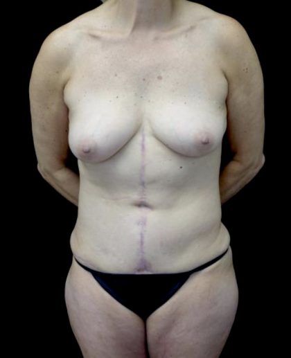 Breast Implant Removal (Explant Surgery) Before & After Patient #22273