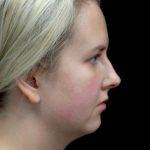 Chin Implants (Augmentation) Before & After Patient #22178