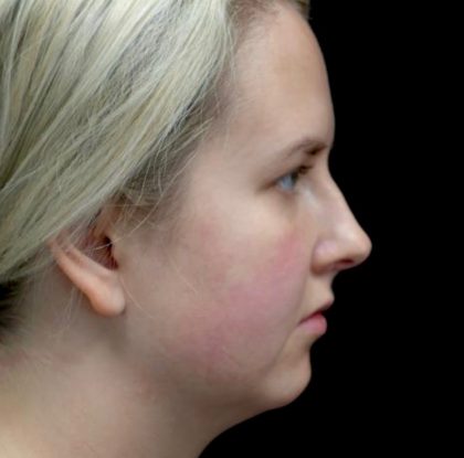 Chin Implants (Augmentation) Before & After Patient #22178