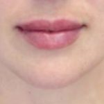 Lip Augmentation - Fillers Before & After Patient #22053