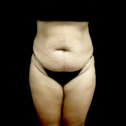 Lipoabdominoplasty Before & After Patient #22254