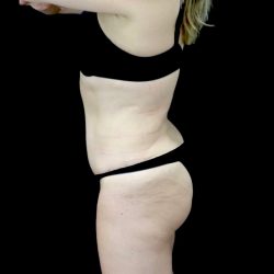 Buttock Augmentation Before & After Patient #22411