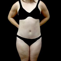 Lipoabdominoplasty Before & After Patient #22418