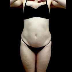 Lipoabdominoplasty Before & After Patient #22418