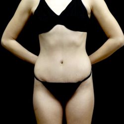 Tummy Tuck Before & After Patient #22210