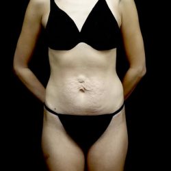 Tummy Tuck Before & After Patient #22210