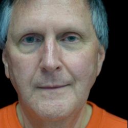 Facelift Before & After Patient #22552