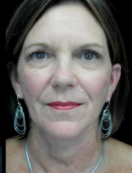 Facelift Before & After Patient #22560