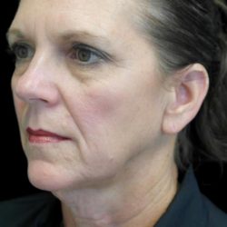 Facelift Before & After Patient #22560