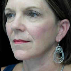 Facelift Before & After Patient #22560