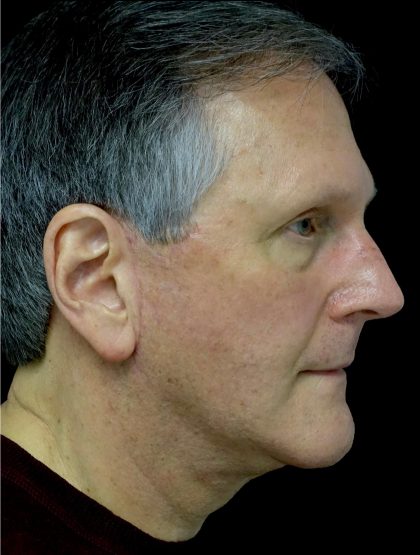Facelift Before & After Patient #22552