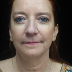 Facelift Before & After Patient #22515