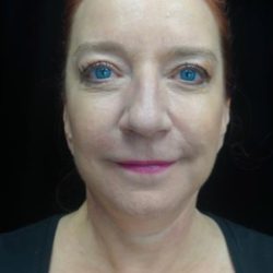 Facelift Before & After Patient #22515