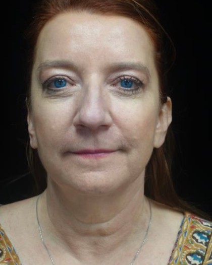 Facelift Before & After Patient #22515