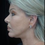 Facelift Before & After Patient #22503