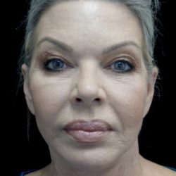 Facelift Before & After Patient #22503
