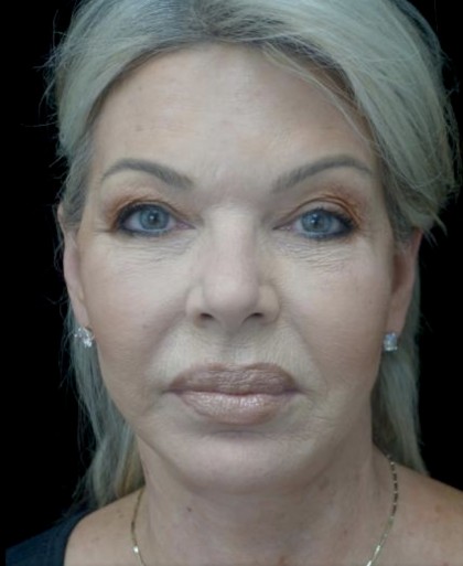 Facelift Before & After Patient #22503