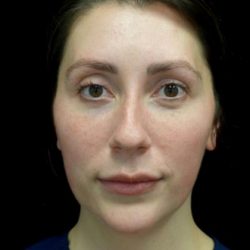 Chin & Jawline Filler Before & After Patient #22558