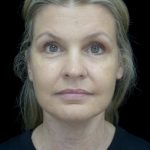 Facelift Before & After Patient #22493