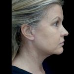 Facelift Before & After Patient #22493