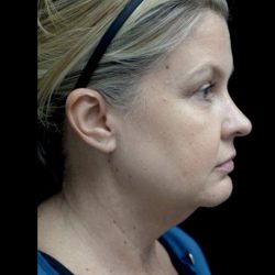 Facelift Before & After Patient #22493