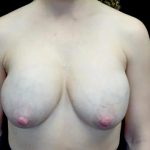 Breast Implant Removal (Explant Surgery) Before & After Patient #22603