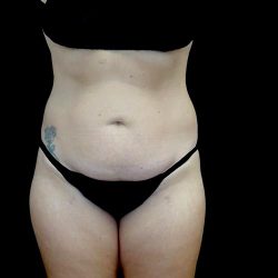 Tummy Tuck Before & After Patient #22584